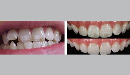 tooth decay process pictures